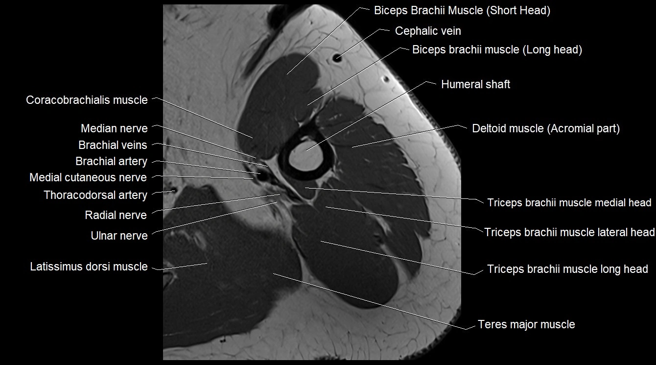 Upper arm( humerus) cross section anatomy MRI 3T axial image 24.webp